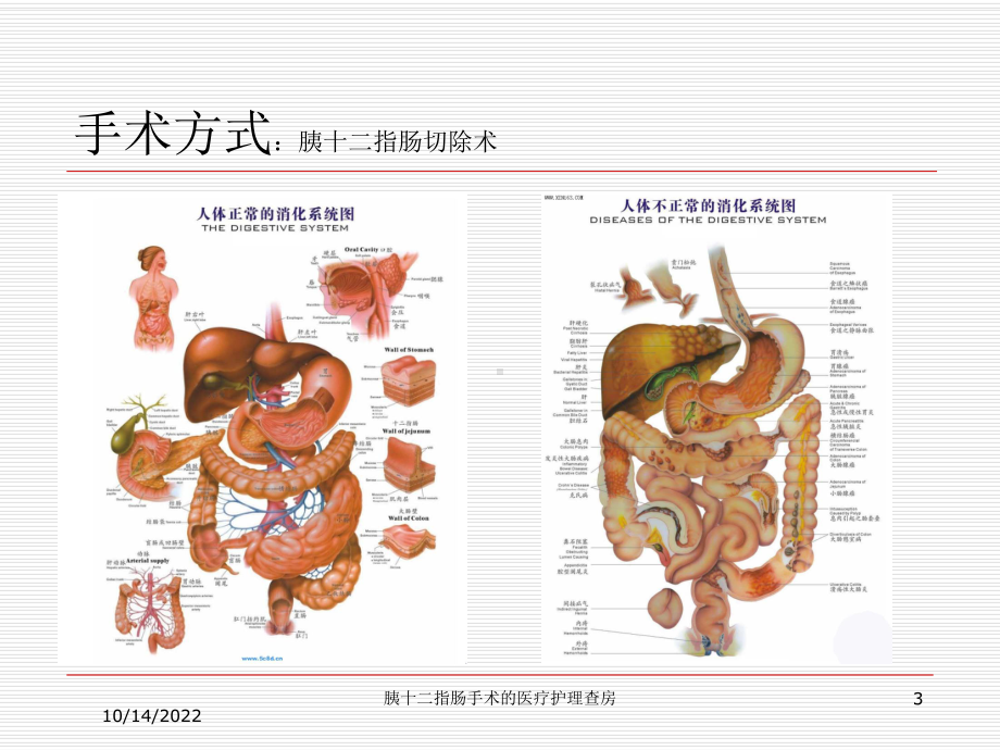 胰十二指肠手术的医疗护理查房培训课件.ppt_第3页