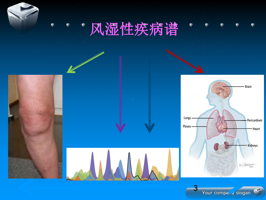 神经精神性红斑狼疮课件.ppt_第3页