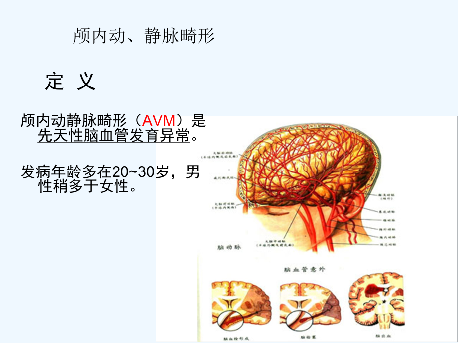 脑血管畸形讲稿课件.pptx_第3页