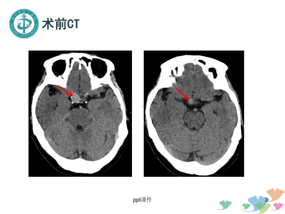 颅内大动脉瘤病例讨论-课件.ppt_第3页