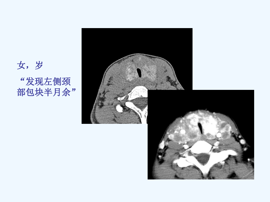 读书报告—小甲状腺癌课件.ppt_第1页