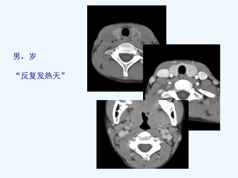 读书报告—小甲状腺癌课件.ppt_第2页