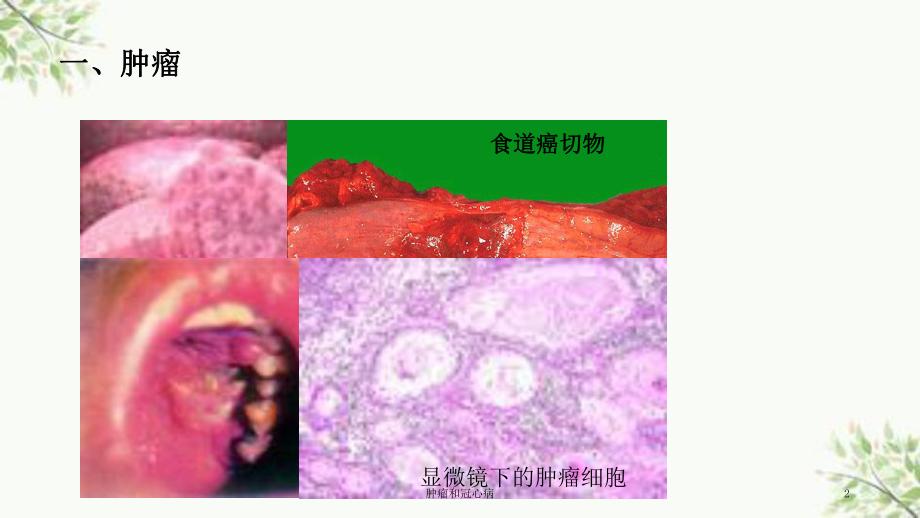 肿瘤和冠心病课件.ppt_第2页