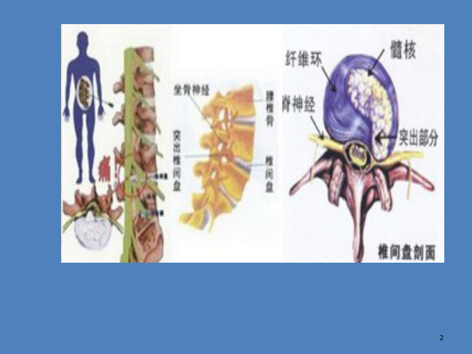 腰椎间盘突出课件.ppt_第2页