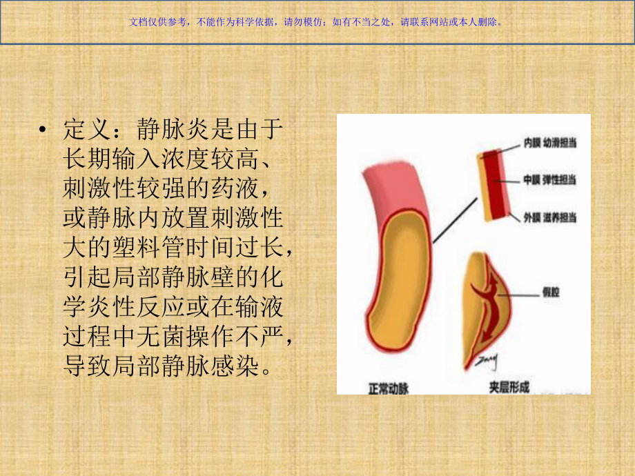 静脉炎的分级和处置宣讲课件.ppt_第2页