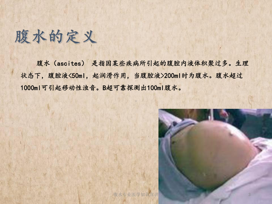 腹水专业医学知识宣讲培训课件.ppt_第3页