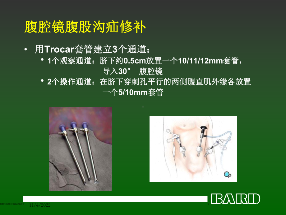 腔镜腹股沟疝修补和DMAX简介培训课件.ppt_第3页