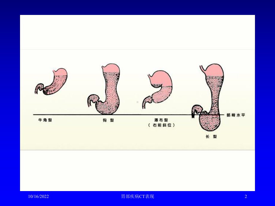 胃部疾病CT表现培训课件.ppt_第2页