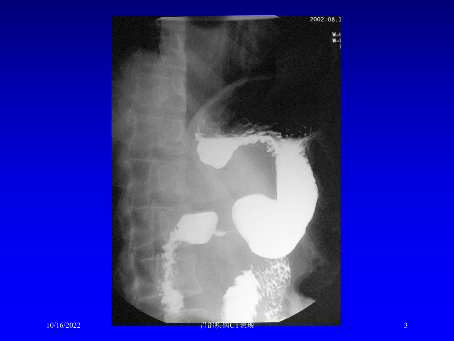 胃部疾病CT表现培训课件.ppt_第3页