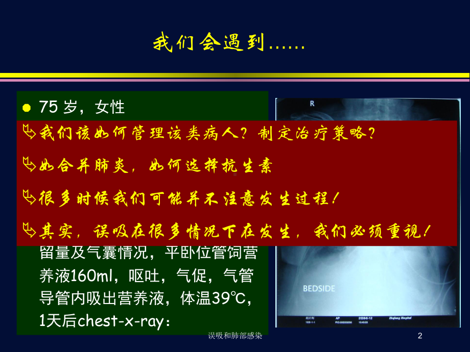 误吸和肺部感染培训课件.ppt_第2页