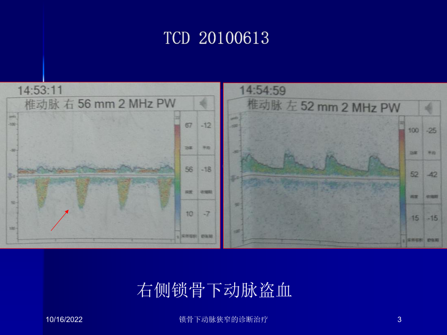 锁骨下动脉狭窄的诊断治疗培训课件.ppt_第3页