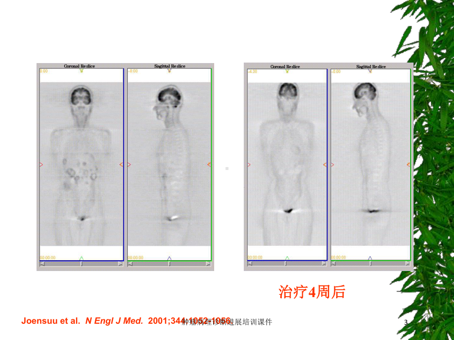 肿瘤病理诊断进展培训课件培训课件.ppt_第3页