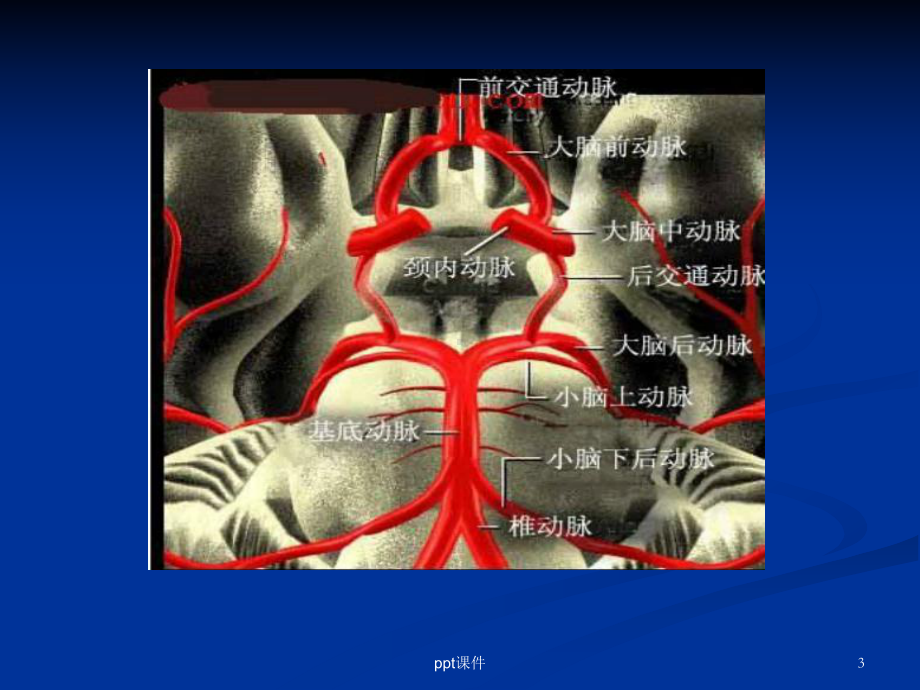 颅内动脉瘤护理查房-课件.ppt_第3页