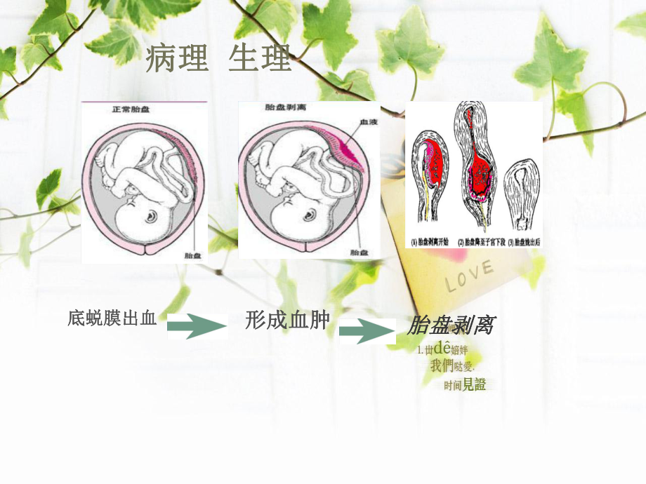 胎盘早剥的诊治与护理课件.ppt_第3页