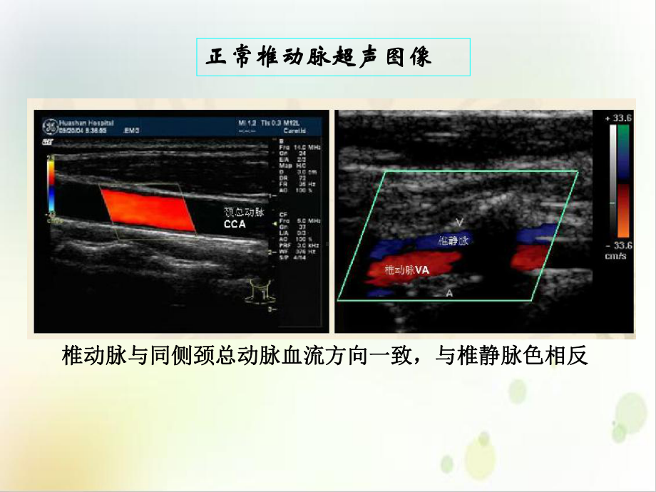 锁骨下动脉盗血课件1.ppt_第3页