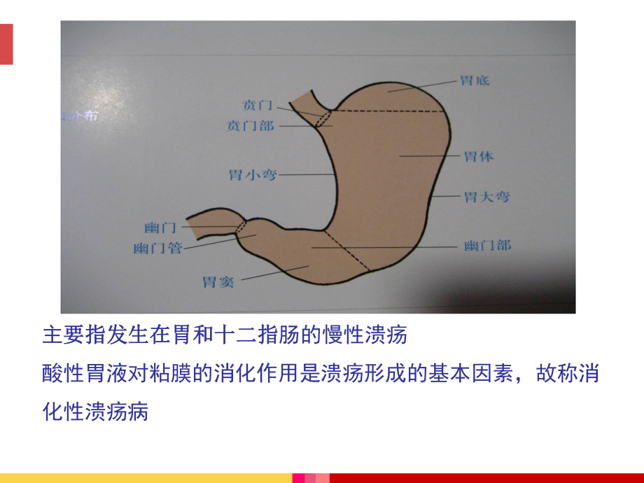 胃疡中医护理方案课件-2.ppt_第2页