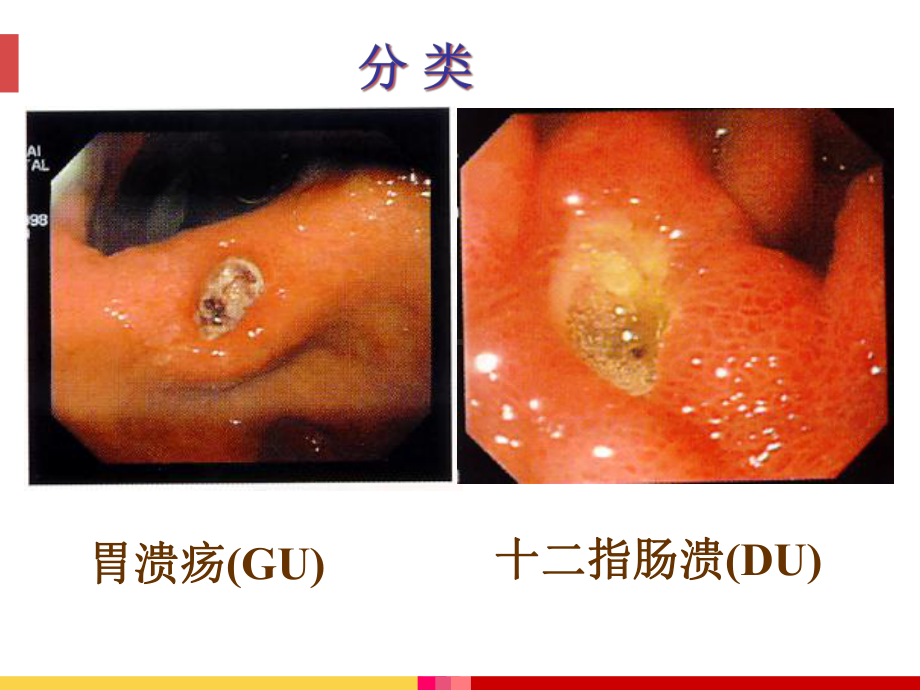 胃疡中医护理方案课件-2.ppt_第3页