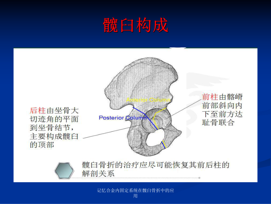 记忆合金内固定系统在髋臼骨折中的应用课件.ppt_第3页