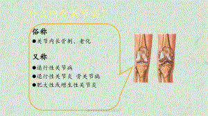 膝关节骨性关节炎的分级治疗课件.ppt