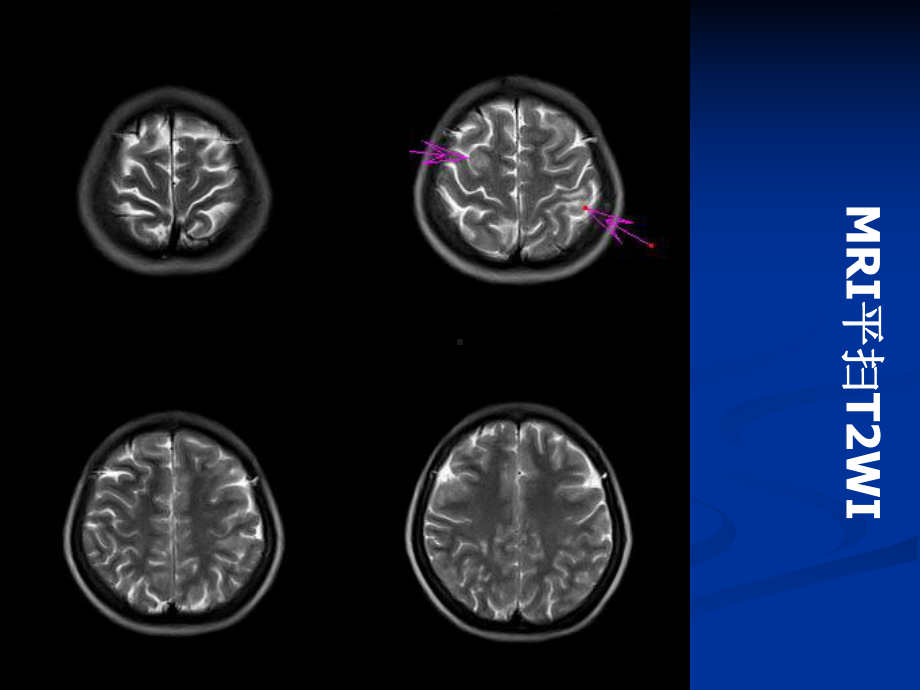 脑结核瘤的MRI诊断与鉴别课件.pptx_第2页