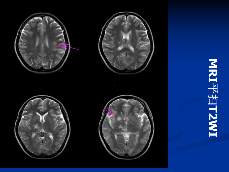 脑结核瘤的MRI诊断与鉴别课件.pptx_第3页