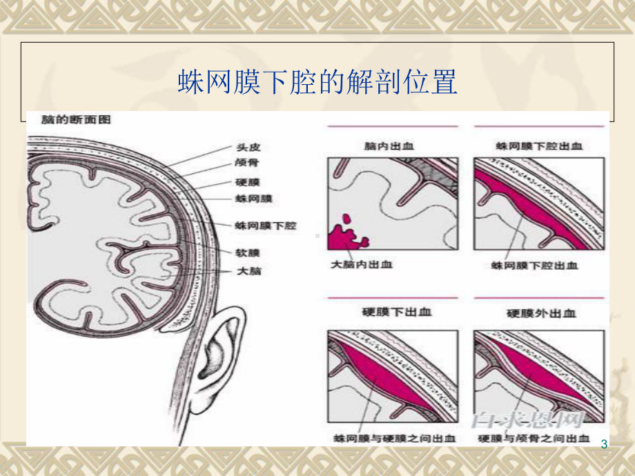 蛛网膜下腔出血病人的护理教学课件.ppt_第3页