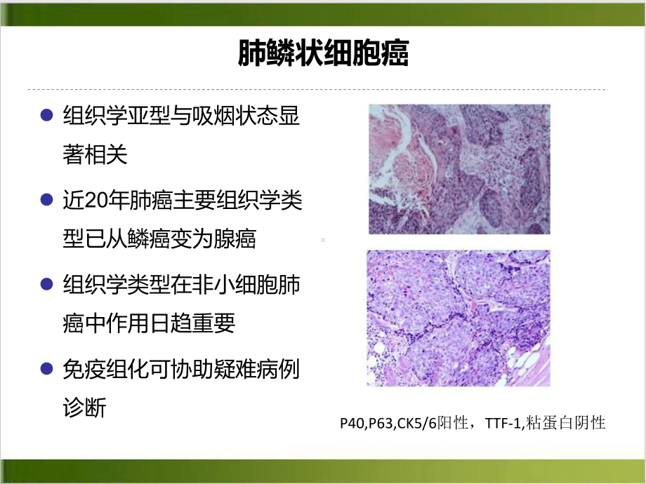 肺鳞癌个体化治疗现状与前景讲课课件.ppt_第3页