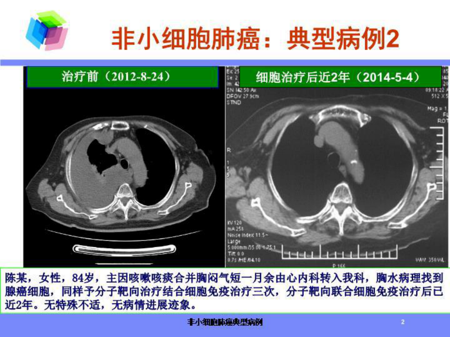 非小细胞肺癌典型病例培训课件.ppt_第2页