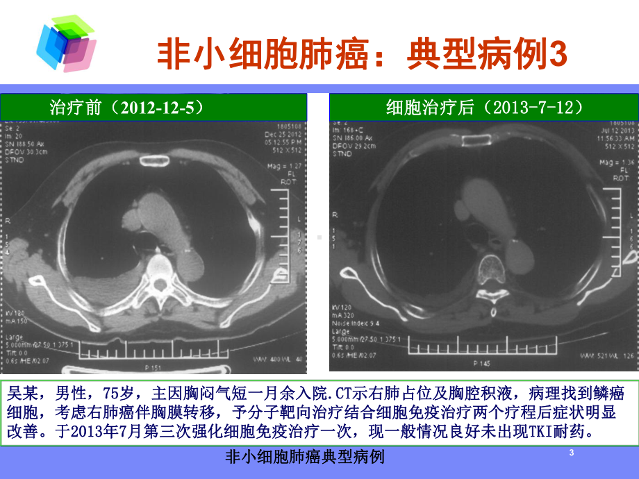 非小细胞肺癌典型病例培训课件.ppt_第3页