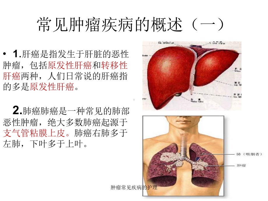 肿瘤常见疾病的护理课件.ppt_第3页