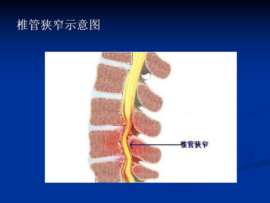 腰椎管狭窄症宣教讲义课件.ppt_第3页