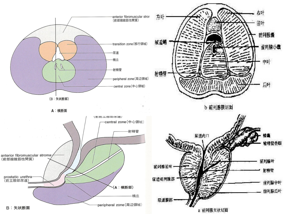 前列腺癌的穿刺活检培训课件1.ppt_第2页