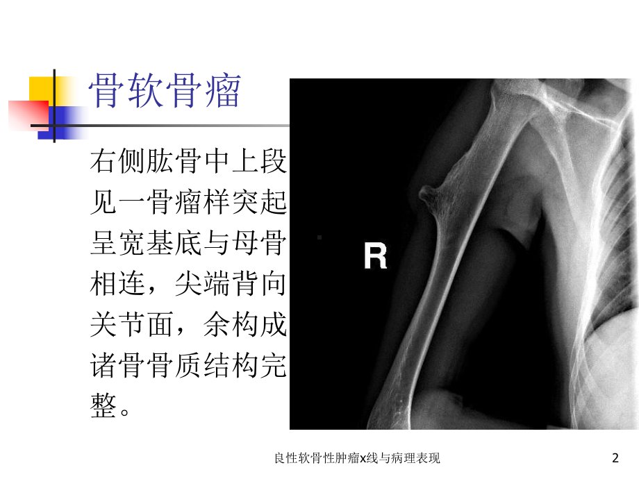 良性软骨性肿瘤x线与病理表现课件.ppt_第2页