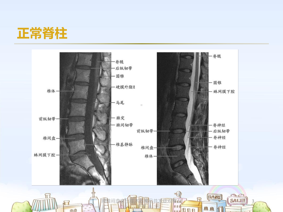 腰椎间盘突出症术后常见并发症观察及护理培训课件.ppt_第3页