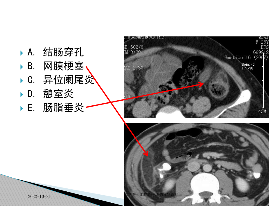 腹腔炎性脂肪性肿块的鉴别诊疗培训课件.ppt_第3页