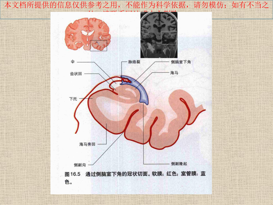 脉络膜裂囊肿的影像学表现和鉴别诊疗培训课件.ppt_第3页