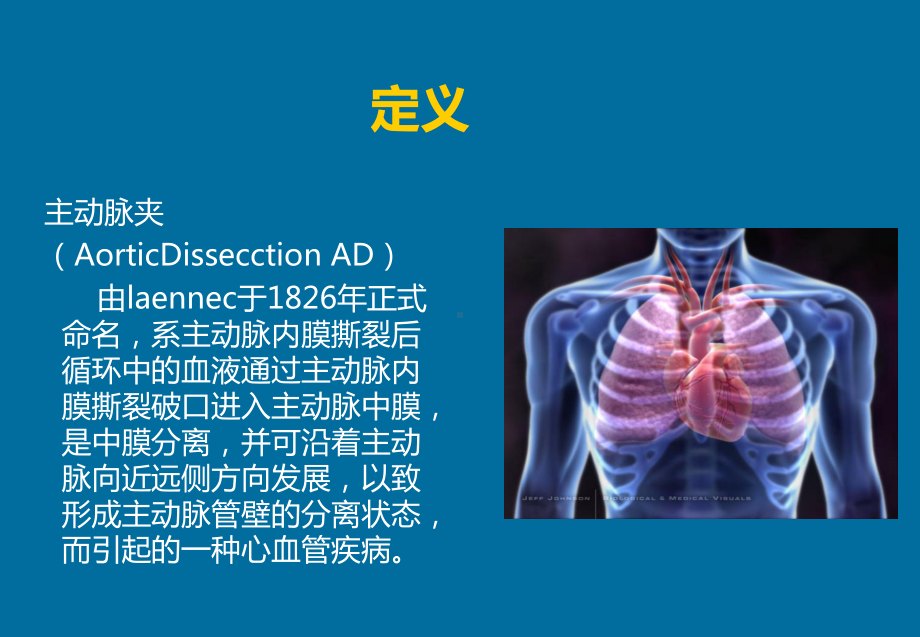 主动脉夹层医学课件.ppt_第2页