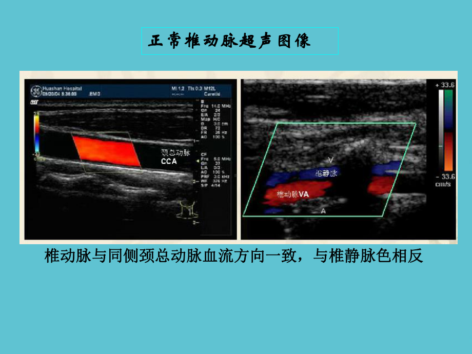 锁骨下动脉盗血课件-2.ppt_第3页