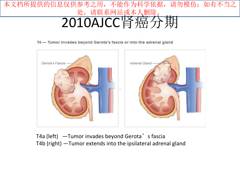 转移性肾癌靶向治疗现状和进展培训课件.ppt_第2页