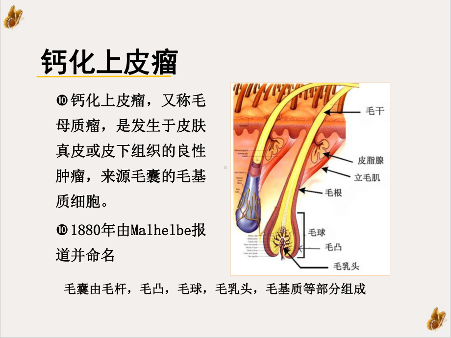 钙化上皮瘤的超声诊断讲课课件.ppt_第2页