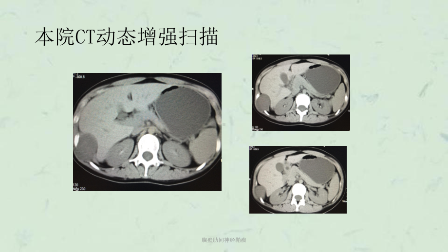 胸壁肋间神经鞘瘤课件.ppt_第3页