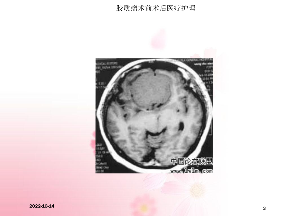 胶质瘤术前术后医疗护理培训课件.ppt_第3页