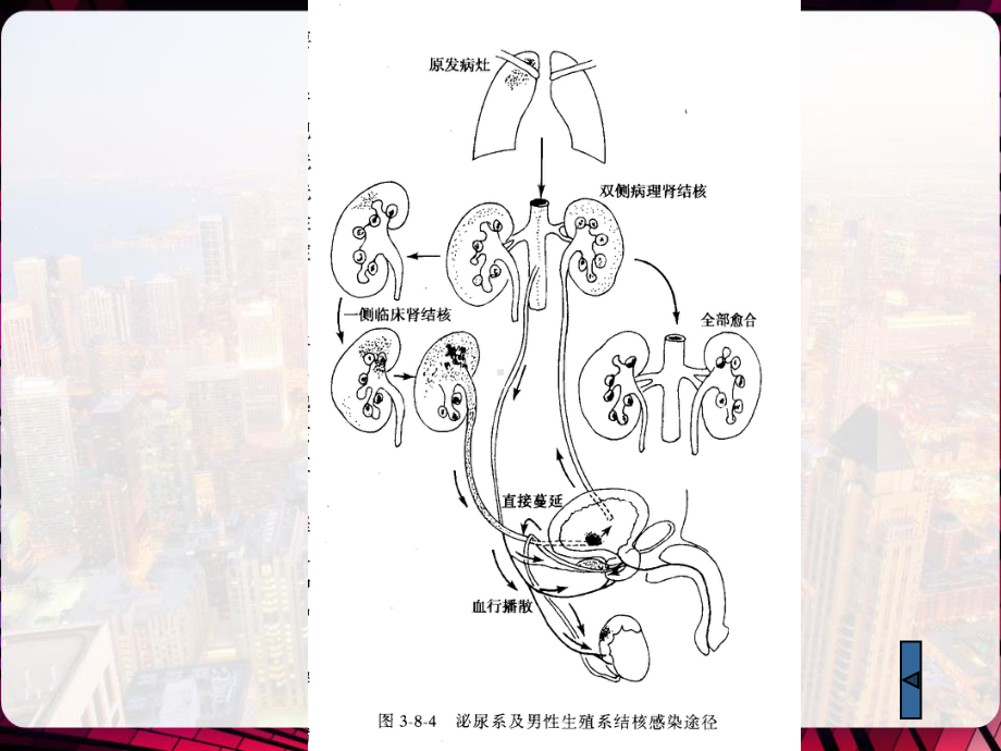 肾结核前列腺增生症病人的护理-课件.pptx_第3页