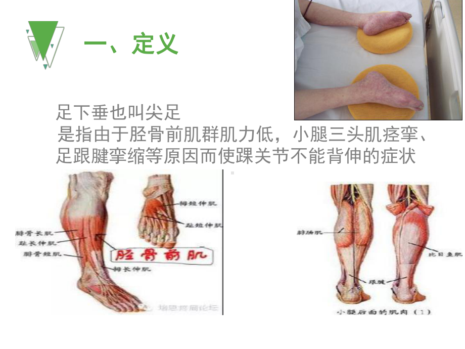 足下垂预防及护理课件.ppt_第3页