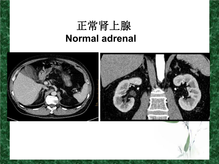 肾上腺静脉分段取血在原发性醛固酮增多症中的应用课件2.ppt_第2页