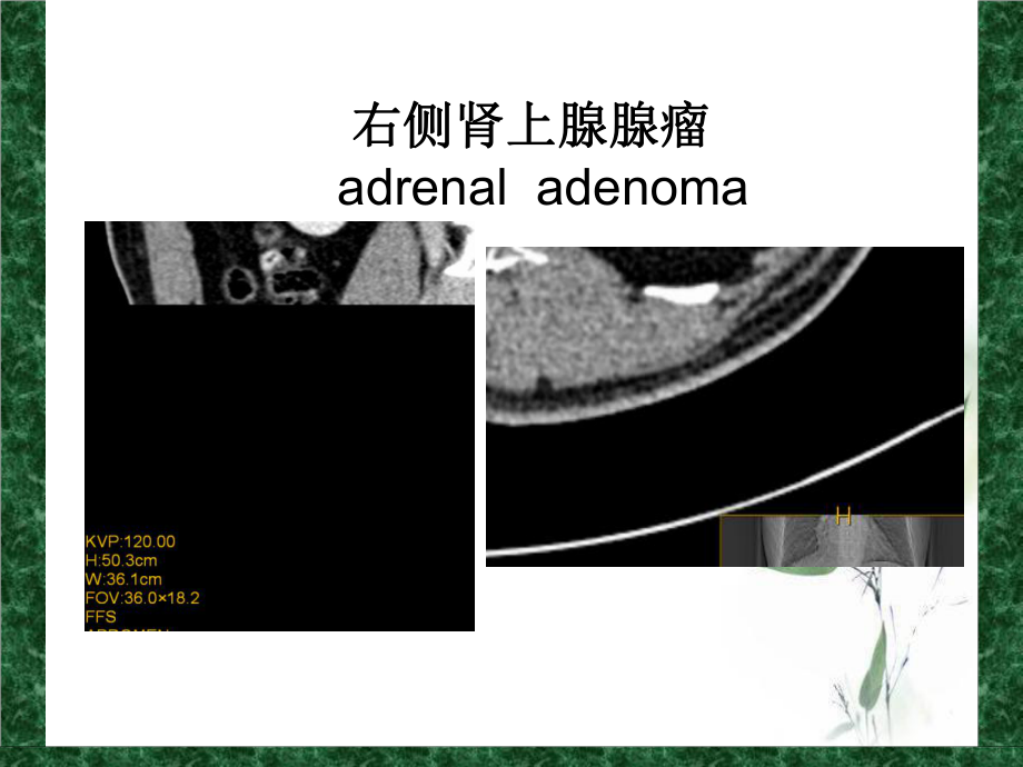 肾上腺静脉分段取血在原发性醛固酮增多症中的应用课件2.ppt_第3页