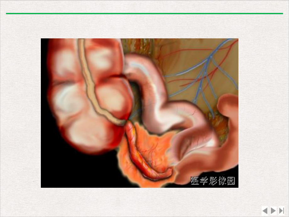 阑尾炎与疑似阑尾炎病变影像表现课件.pptx_第3页