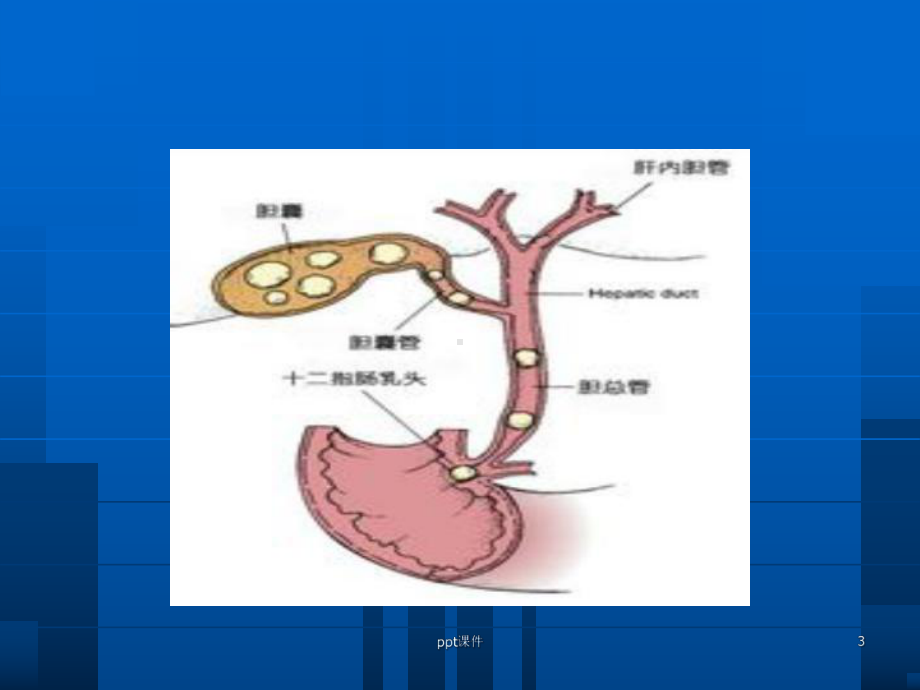 胆囊结石防治-课件.ppt_第3页