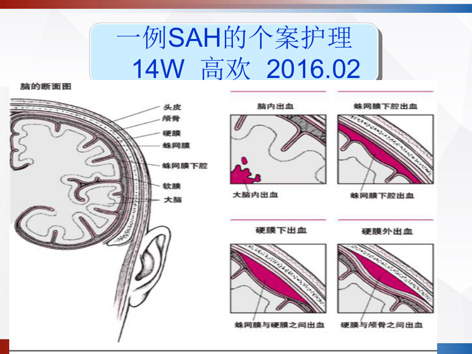 蛛网膜下腔出血的个案护理-课件.ppt_第2页