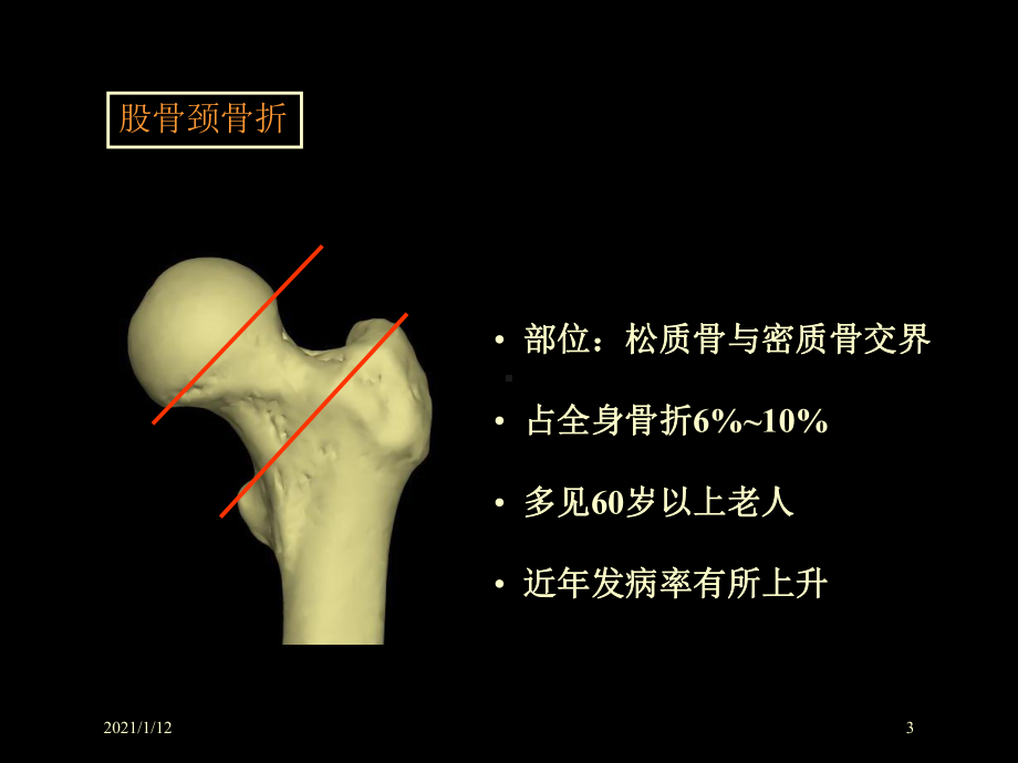 讲课股骨颈骨折课件.ppt_第3页